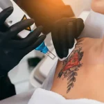 How to Prepare for Your First Tattoo Removal Session