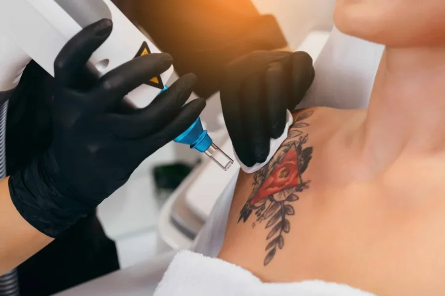 How to Prepare for Your First Tattoo Removal Session